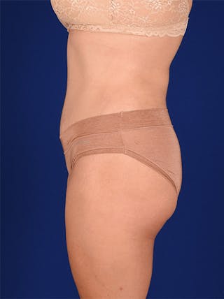 Abdominoplasty / Tummy Tuck Before & After Gallery - Patient 18242353 - Image 6