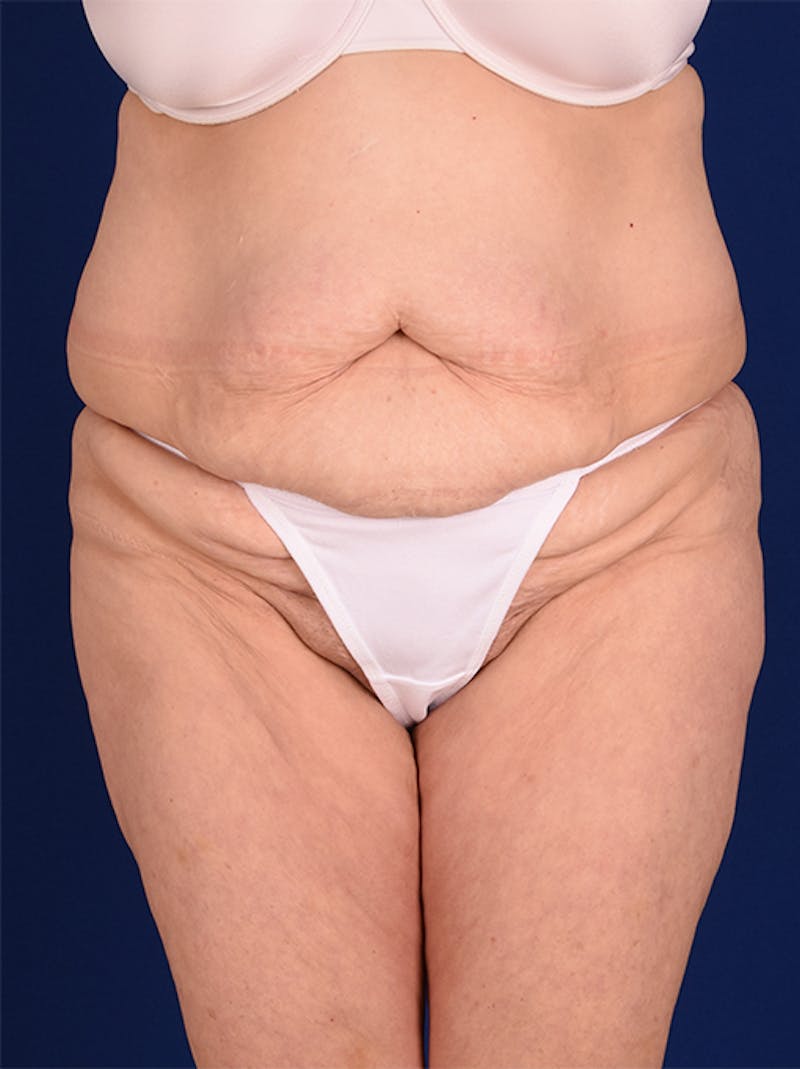 Abdominoplasty / Tummy Tuck Before & After Gallery - Patient 18242367 - Image 1