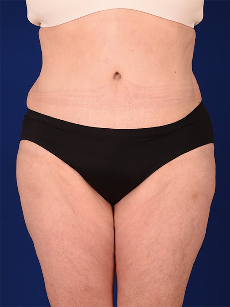 Abdominoplasty / Tummy Tuck Before & After Gallery - Patient 18242367 - Image 2