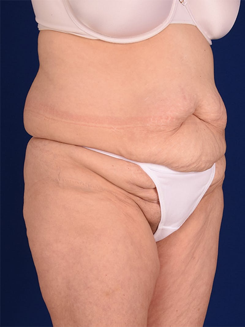 Abdominoplasty / Tummy Tuck Before & After Gallery - Patient 18242367 - Image 3
