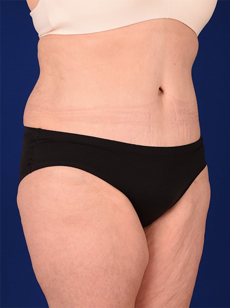 Abdominoplasty / Tummy Tuck Before & After Gallery - Patient 18242367 - Image 4