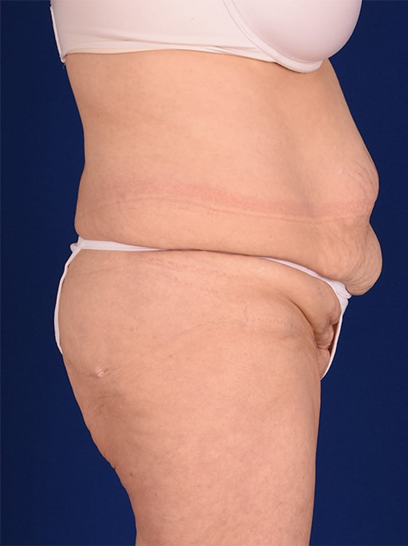 Abdominoplasty / Tummy Tuck Before & After Gallery - Patient 18242367 - Image 5