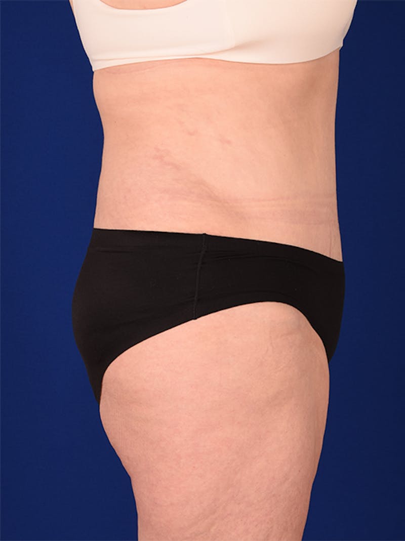 Abdominoplasty / Tummy Tuck Before & After Gallery - Patient 18242367 - Image 6