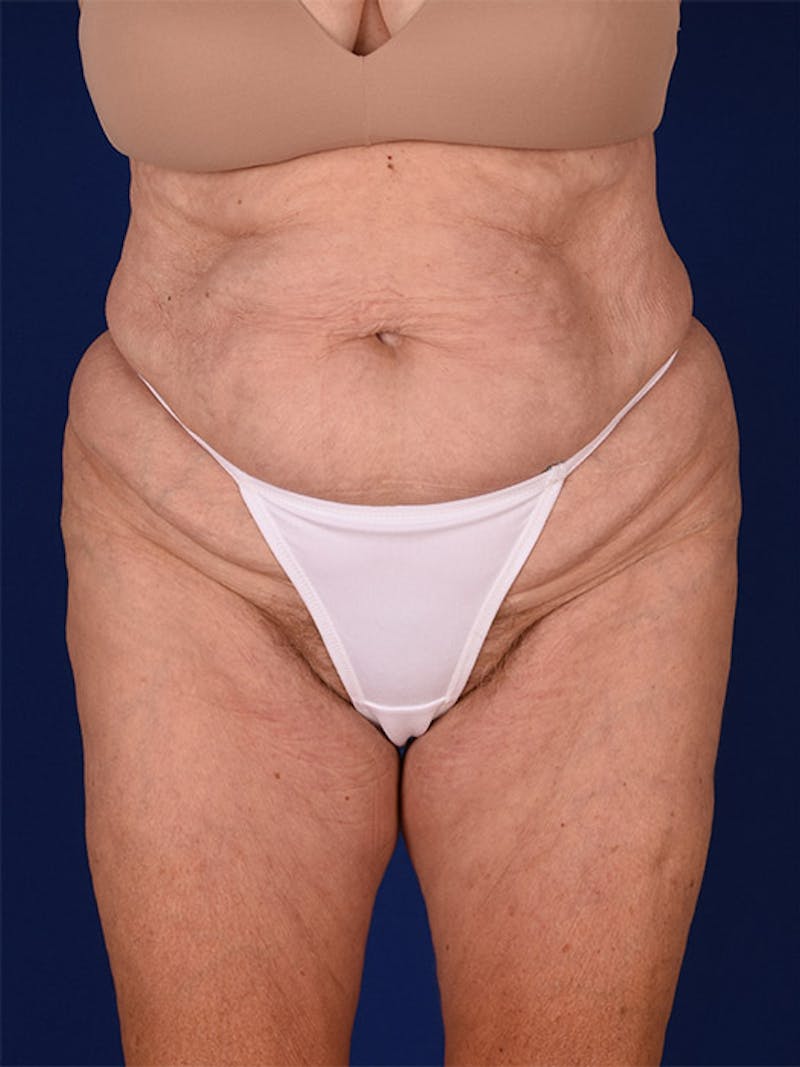Abdominoplasty / Tummy Tuck Before & After Gallery - Patient 18242371 - Image 1