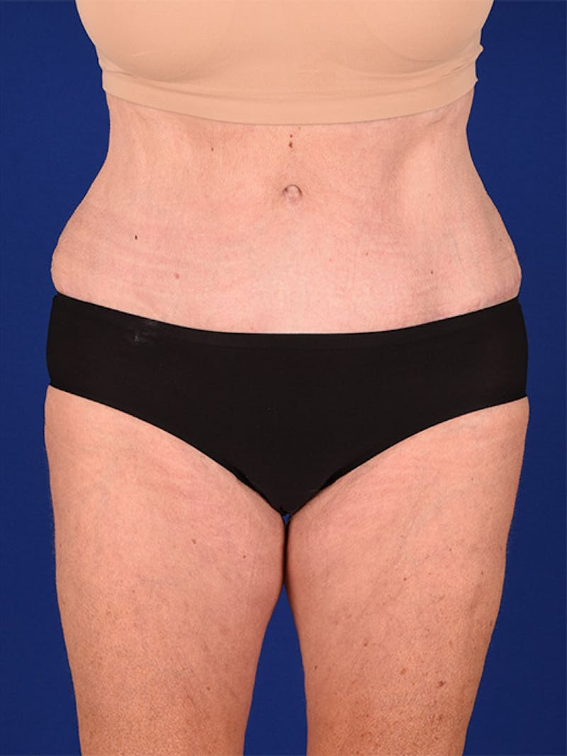 Abdominoplasty / Tummy Tuck Before & After Gallery - Patient 18242371 - Image 2