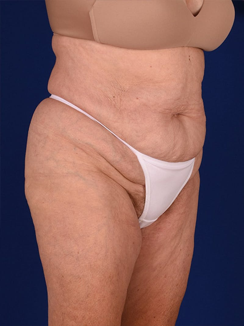 Abdominoplasty / Tummy Tuck Before & After Gallery - Patient 18242371 - Image 3