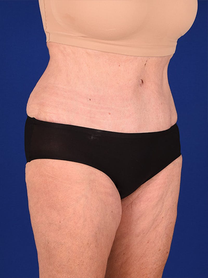 Abdominoplasty / Tummy Tuck Before & After Gallery - Patient 18242371 - Image 4