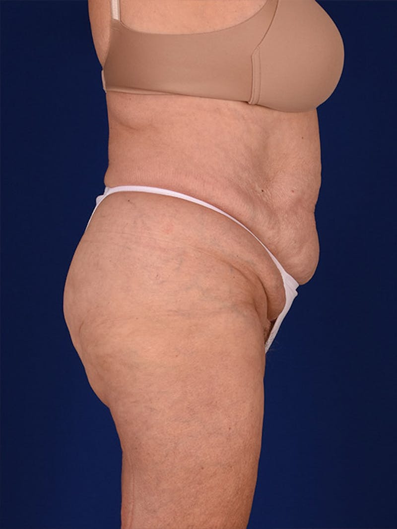 Abdominoplasty / Tummy Tuck Before & After Gallery - Patient 18242371 - Image 5