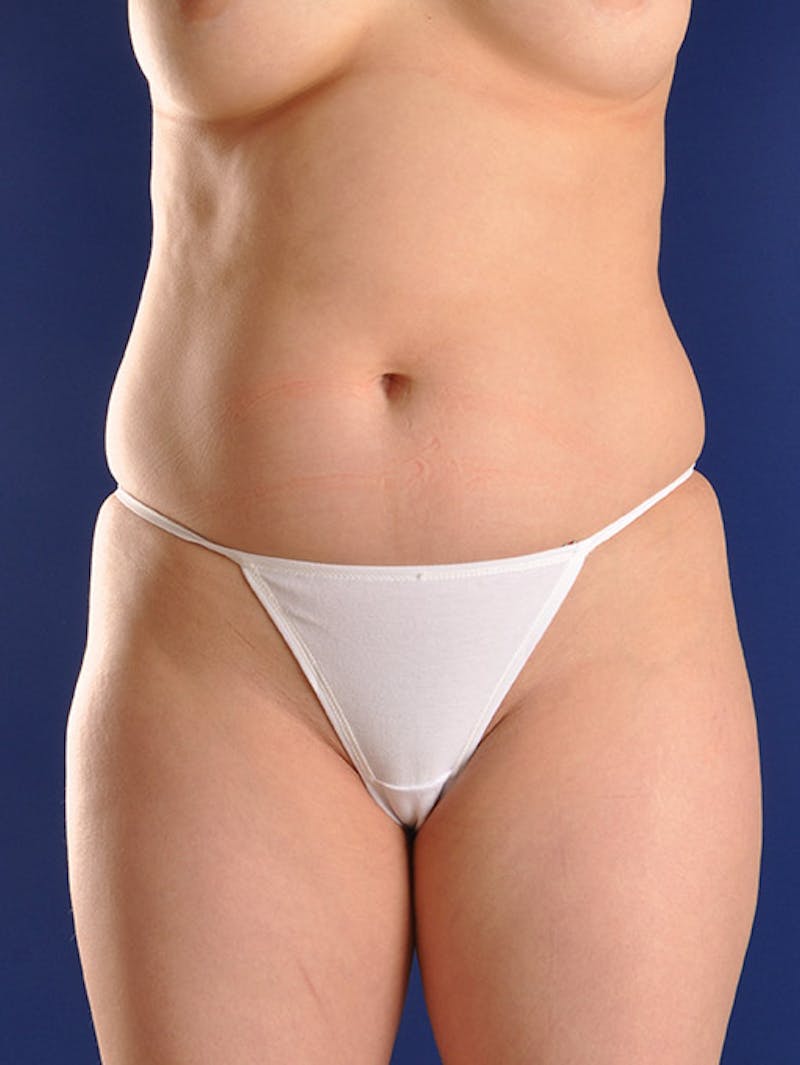 Liposuction Before & After Gallery - Patient 18242413 - Image 1