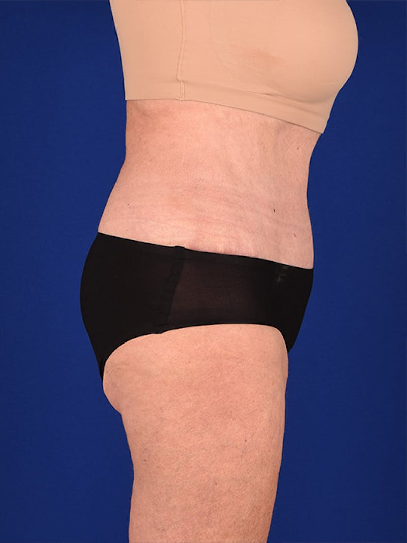 Abdominoplasty / Tummy Tuck Before & After Gallery - Patient 18242371 - Image 6