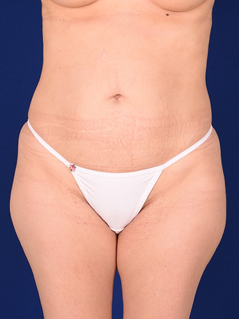 Abdominoplasty / Tummy Tuck Before & After Gallery - Patient 18242415 - Image 1