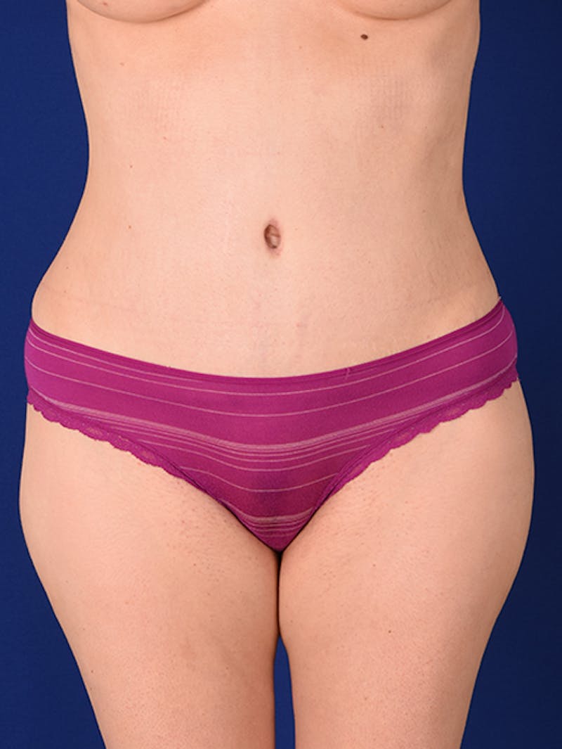 Abdominoplasty / Tummy Tuck Before & After Gallery - Patient 18242415 - Image 2