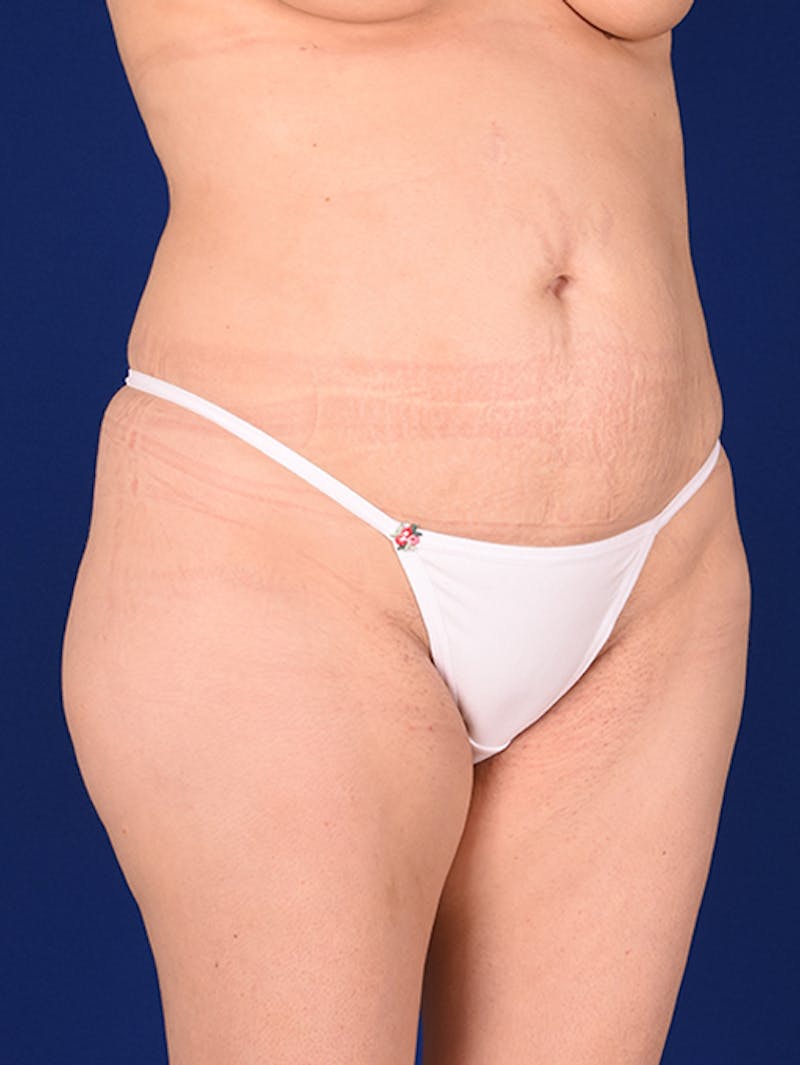 Abdominoplasty / Tummy Tuck Before & After Gallery - Patient 18242415 - Image 3