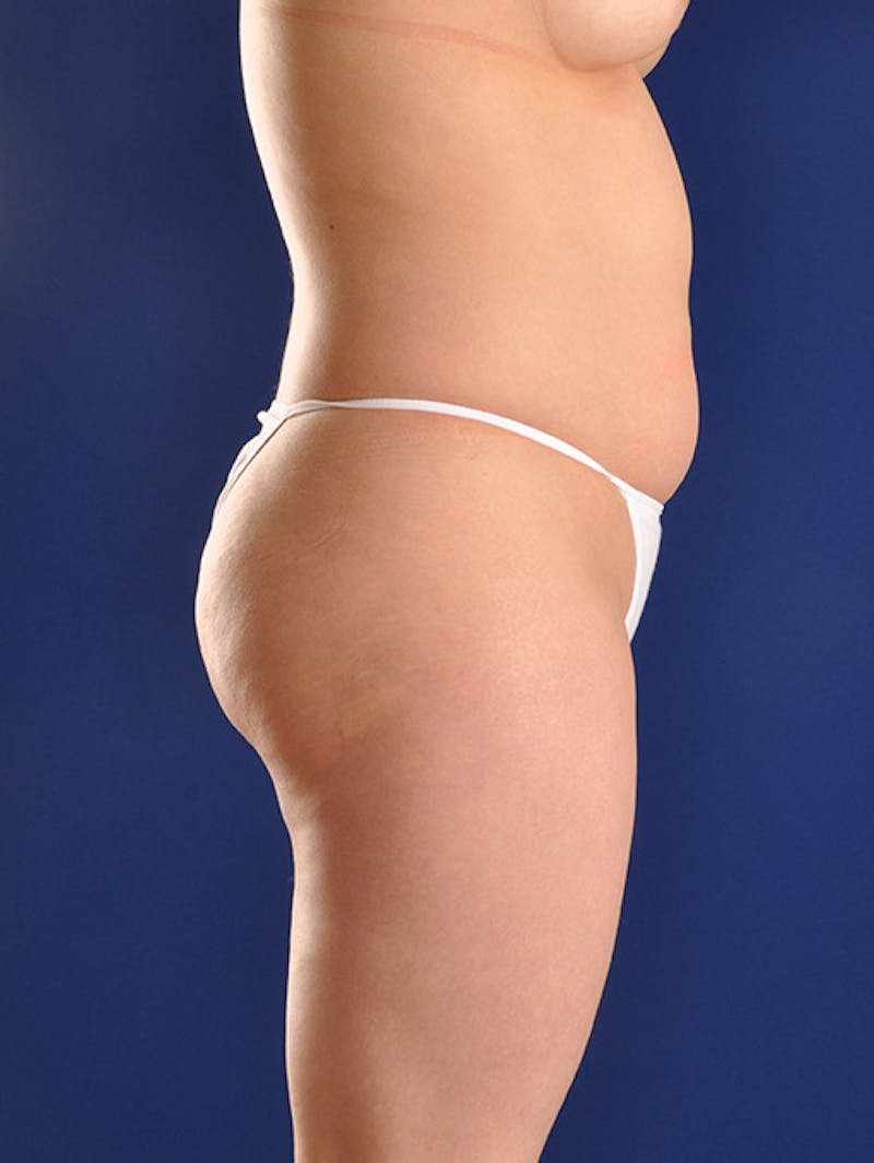Liposuction Before & After Gallery - Patient 18242413 - Image 5