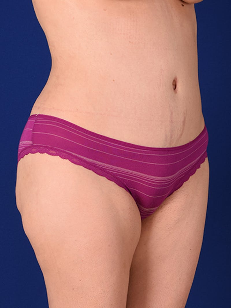 Abdominoplasty / Tummy Tuck Before & After Gallery - Patient 18242415 - Image 4