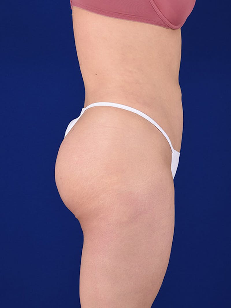 Liposuction Before & After Gallery - Patient 18242413 - Image 6