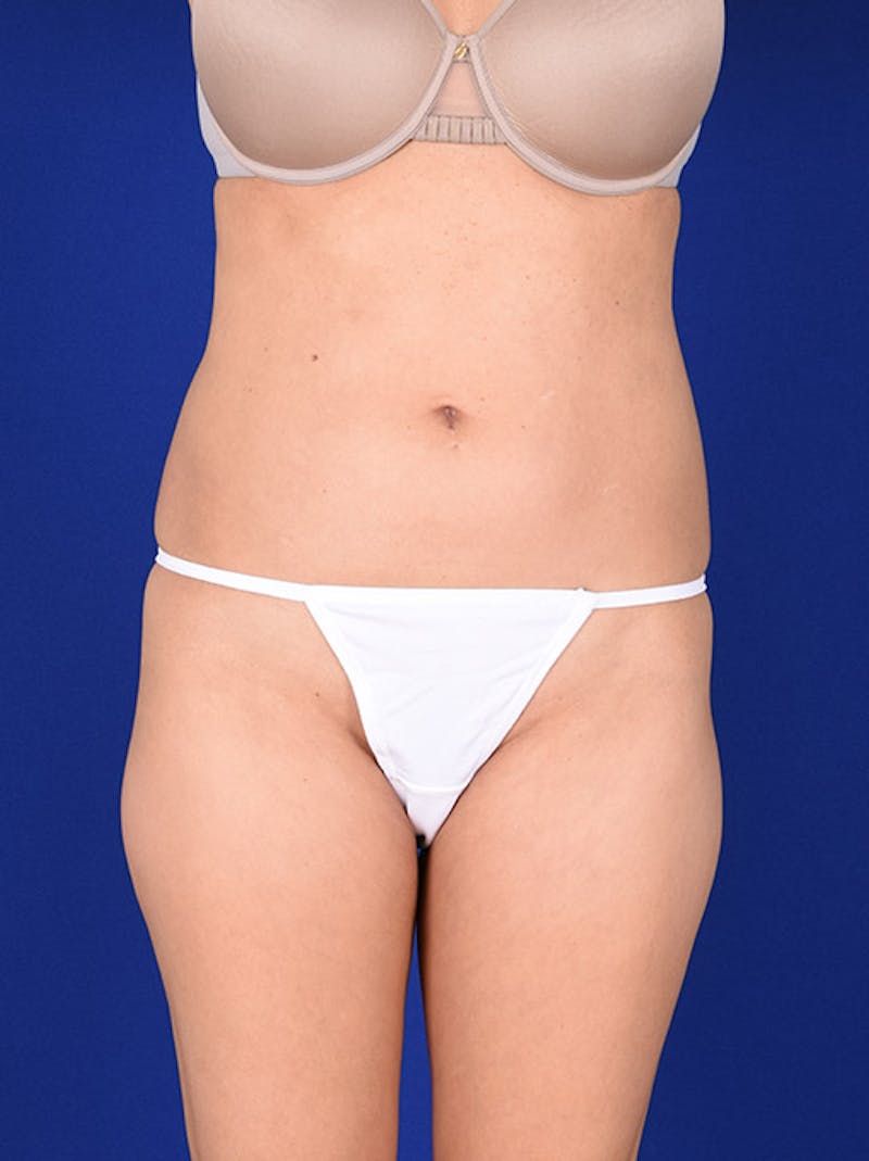 Liposuction Before & After Gallery - Patient 18242416 - Image 1