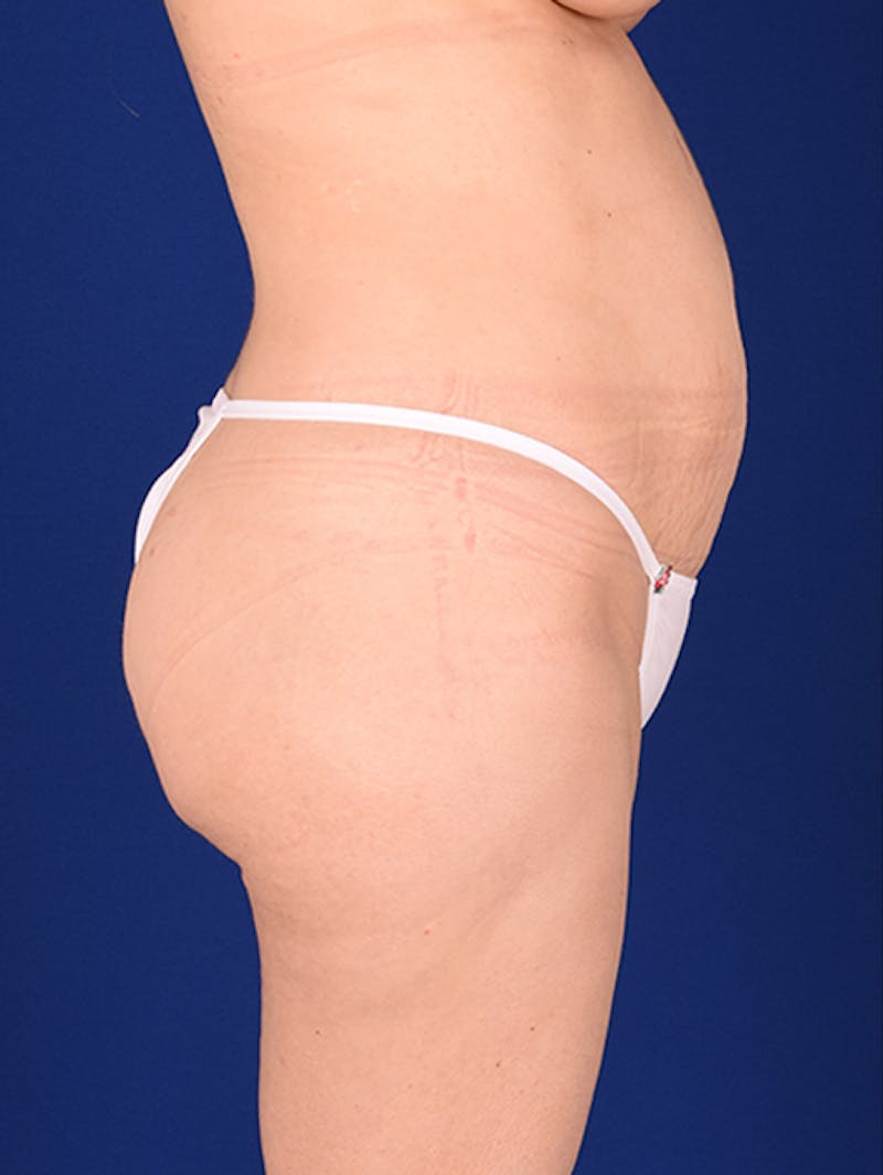Abdominoplasty / Tummy Tuck Before & After Gallery - Patient 18242415 - Image 5