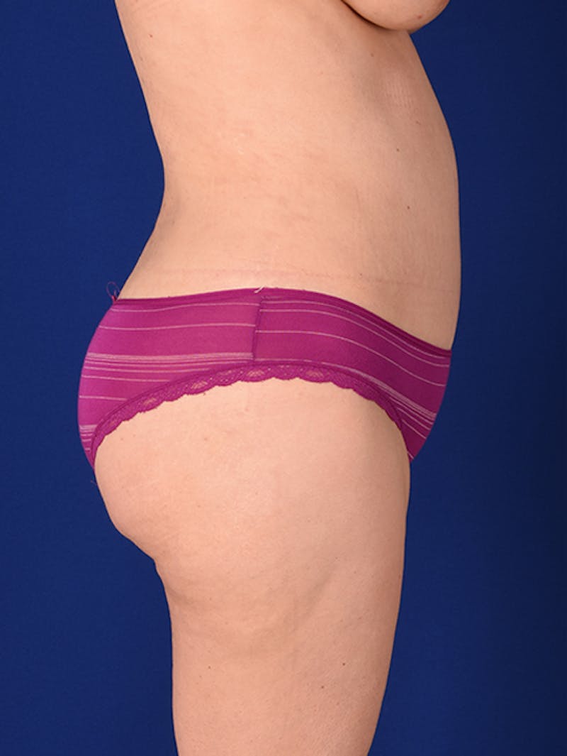 Abdominoplasty / Tummy Tuck Before & After Gallery - Patient 18242415 - Image 6