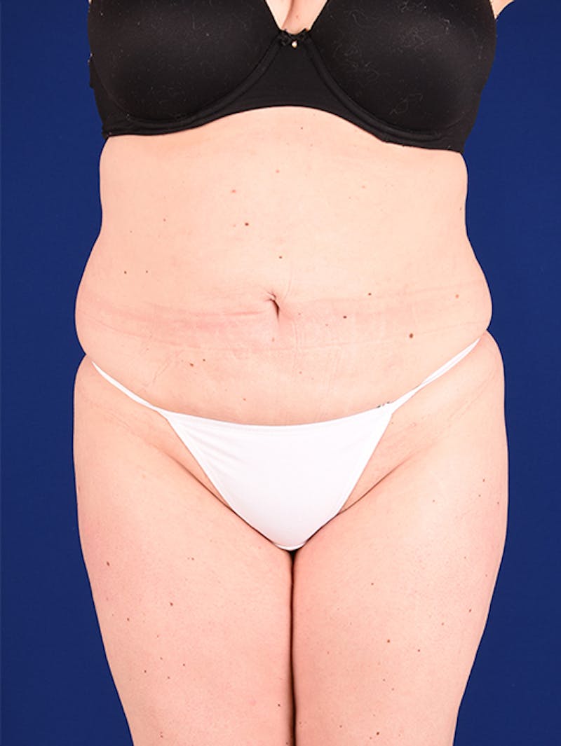 Abdominoplasty / Tummy Tuck Before & After Gallery - Patient 18242419 - Image 1