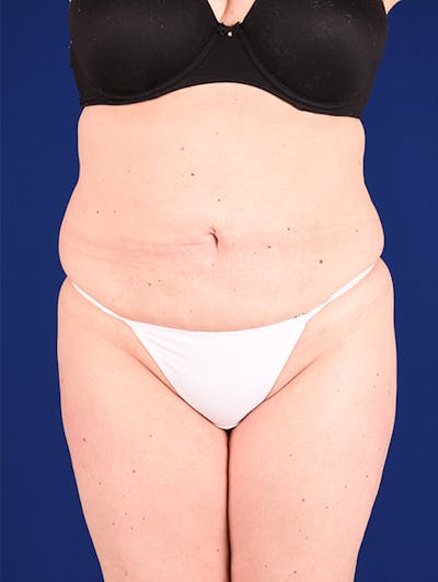 Abdominoplasty / Tummy Tuck Before & After Gallery - Patient 18242419 - Image 1
