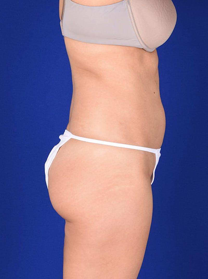 Liposuction Before & After Gallery - Patient 18242416 - Image 5