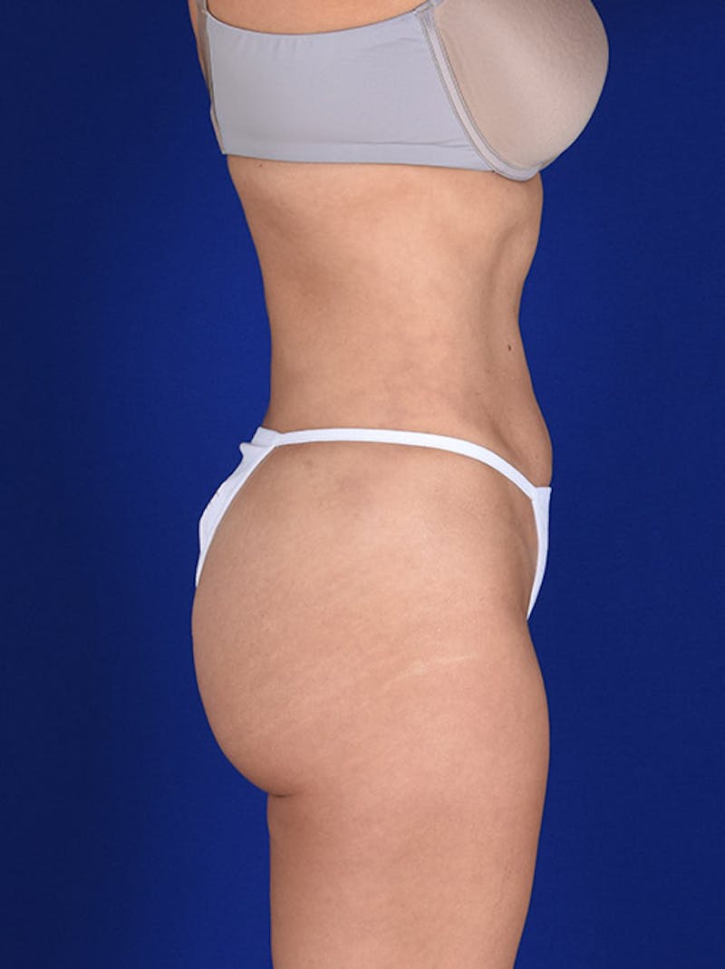 Liposuction Before & After Gallery - Patient 18242416 - Image 6