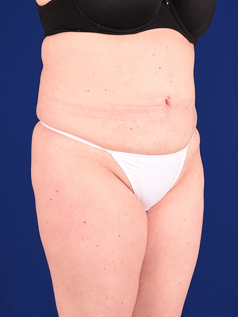 Abdominoplasty / Tummy Tuck Before & After Gallery - Patient 18242419 - Image 3