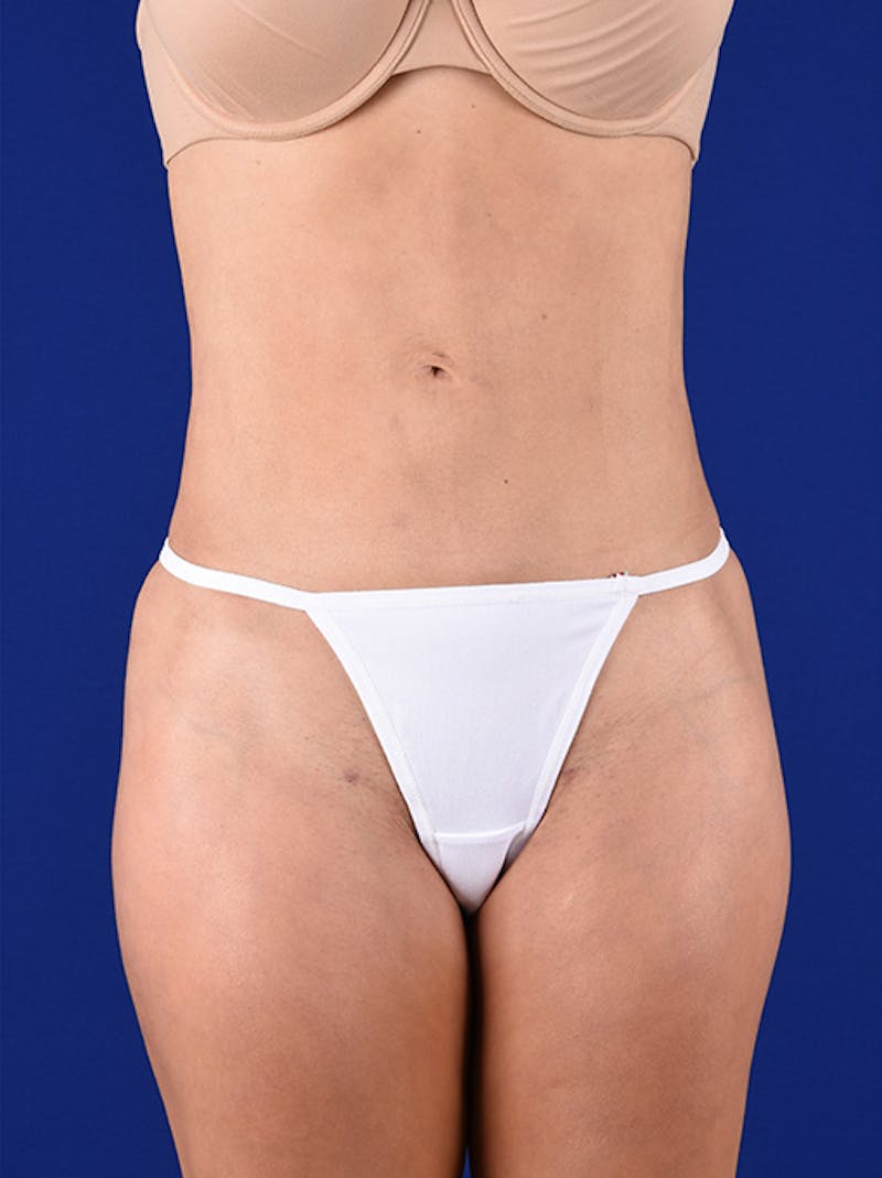Liposuction Before & After Gallery - Patient 18242421 - Image 2