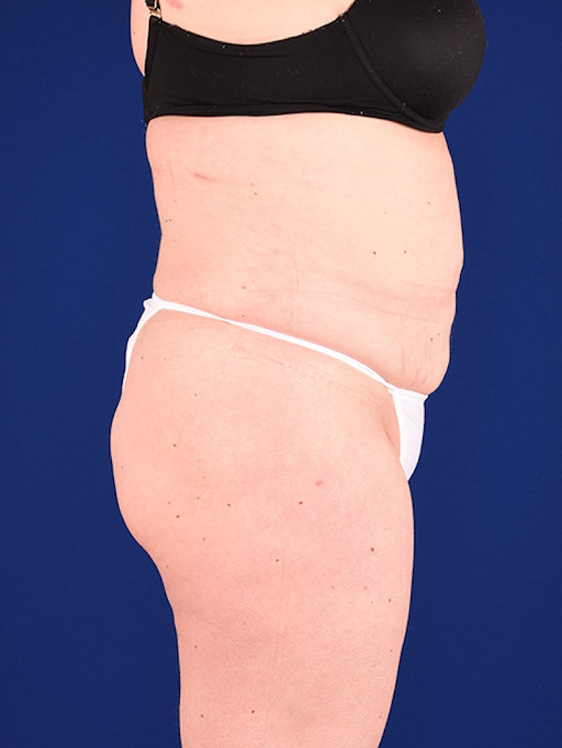 Abdominoplasty / Tummy Tuck Before & After Gallery - Patient 18242419 - Image 5