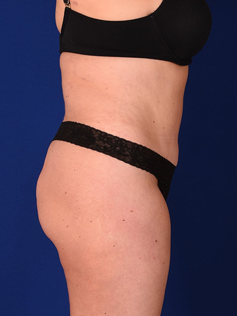 Abdominoplasty / Tummy Tuck Before & After Gallery - Patient 18242419 - Image 6