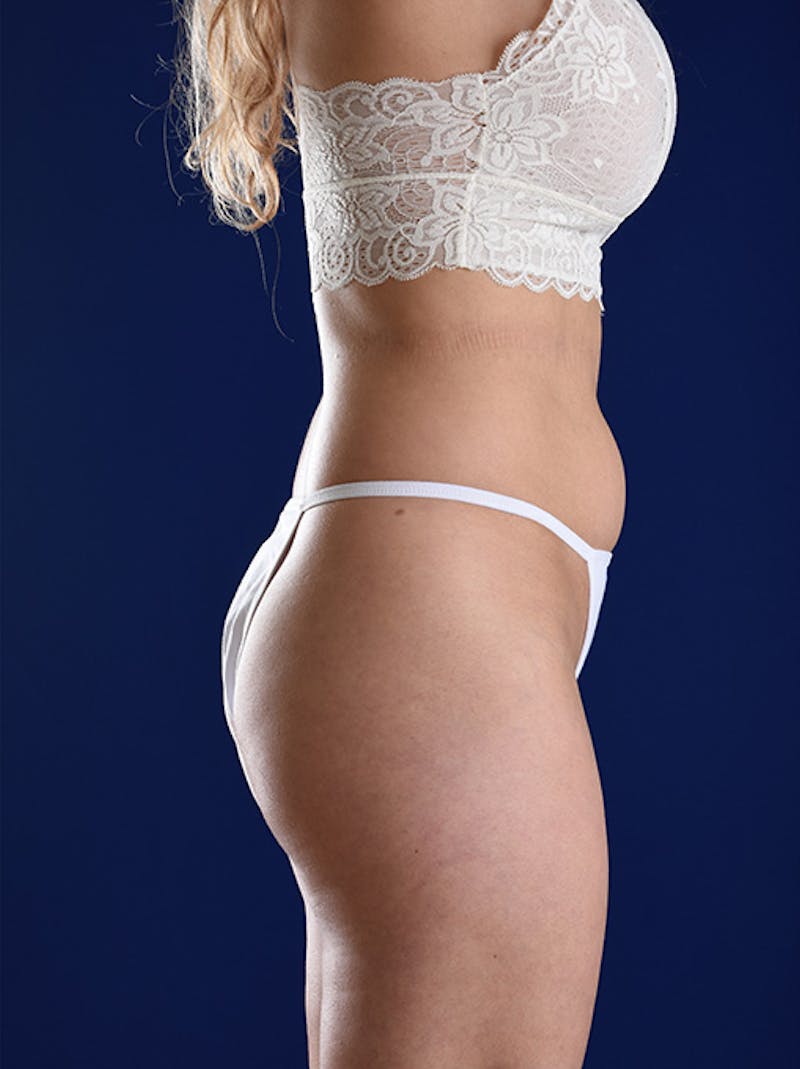 Liposuction Before & After Gallery - Patient 18242421 - Image 5
