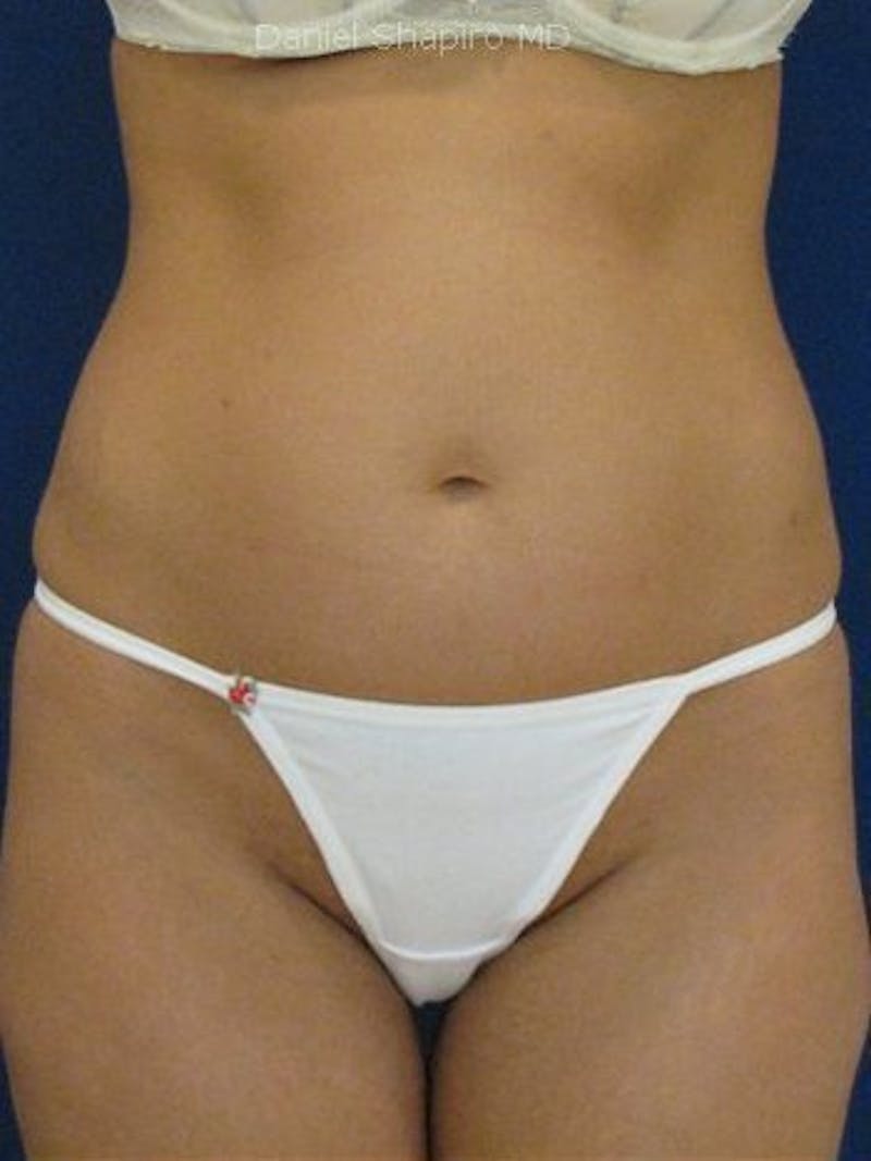 Abdominoplasty / Tummy Tuck Before & After Gallery - Patient 18242422 - Image 1