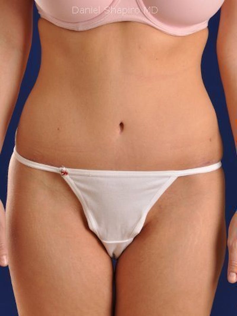 Abdominoplasty / Tummy Tuck Before & After Gallery - Patient 18242422 - Image 2