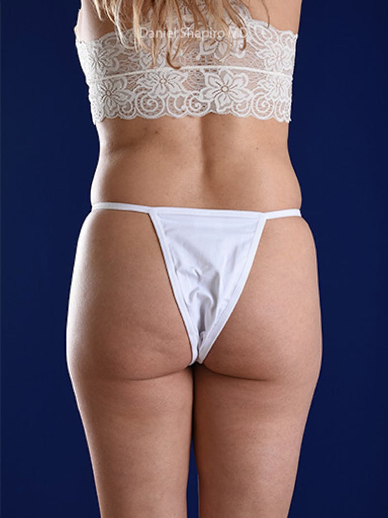 Liposuction Before & After Gallery - Patient 18242421 - Image 7