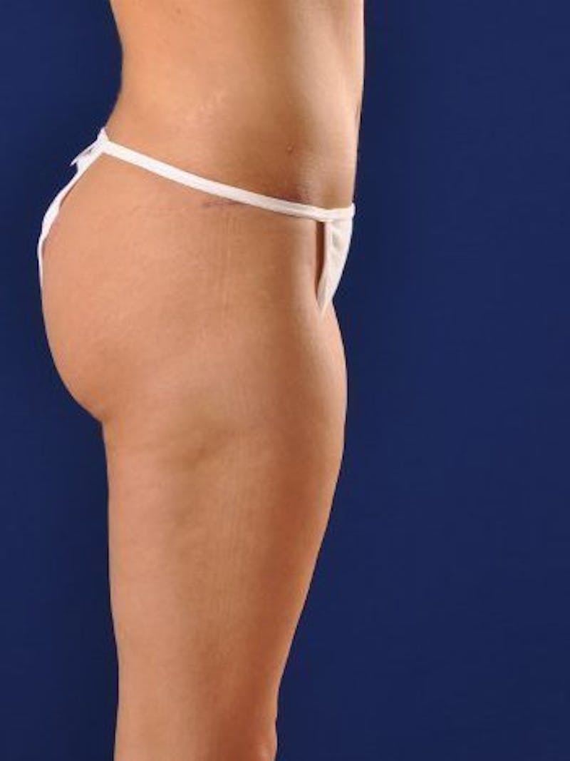 Abdominoplasty / Tummy Tuck Before & After Gallery - Patient 18242422 - Image 4