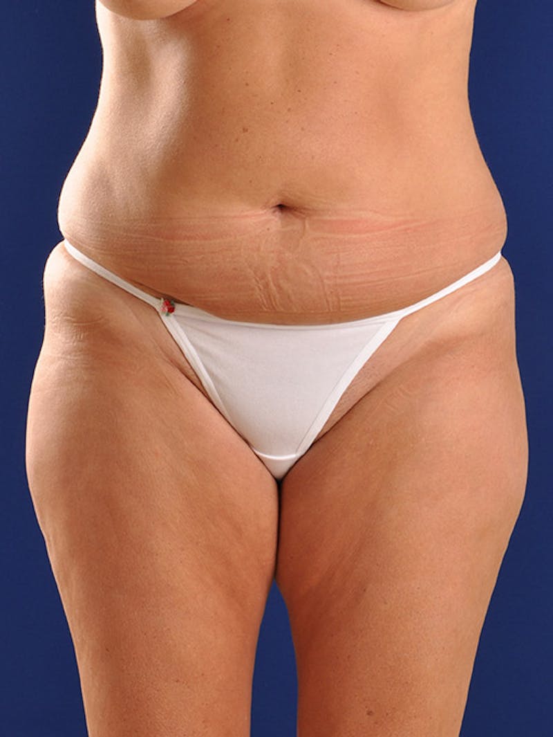 Abdominoplasty / Tummy Tuck Before & After Gallery - Patient 18242440 - Image 1