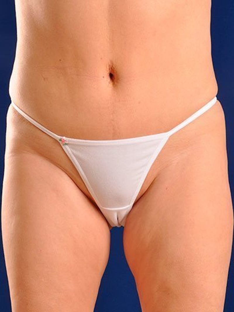 Liposuction Before & After Gallery - Patient 18242431 - Image 1