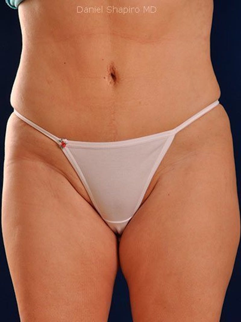 Liposuction Before & After Gallery - Patient 18242431 - Image 2
