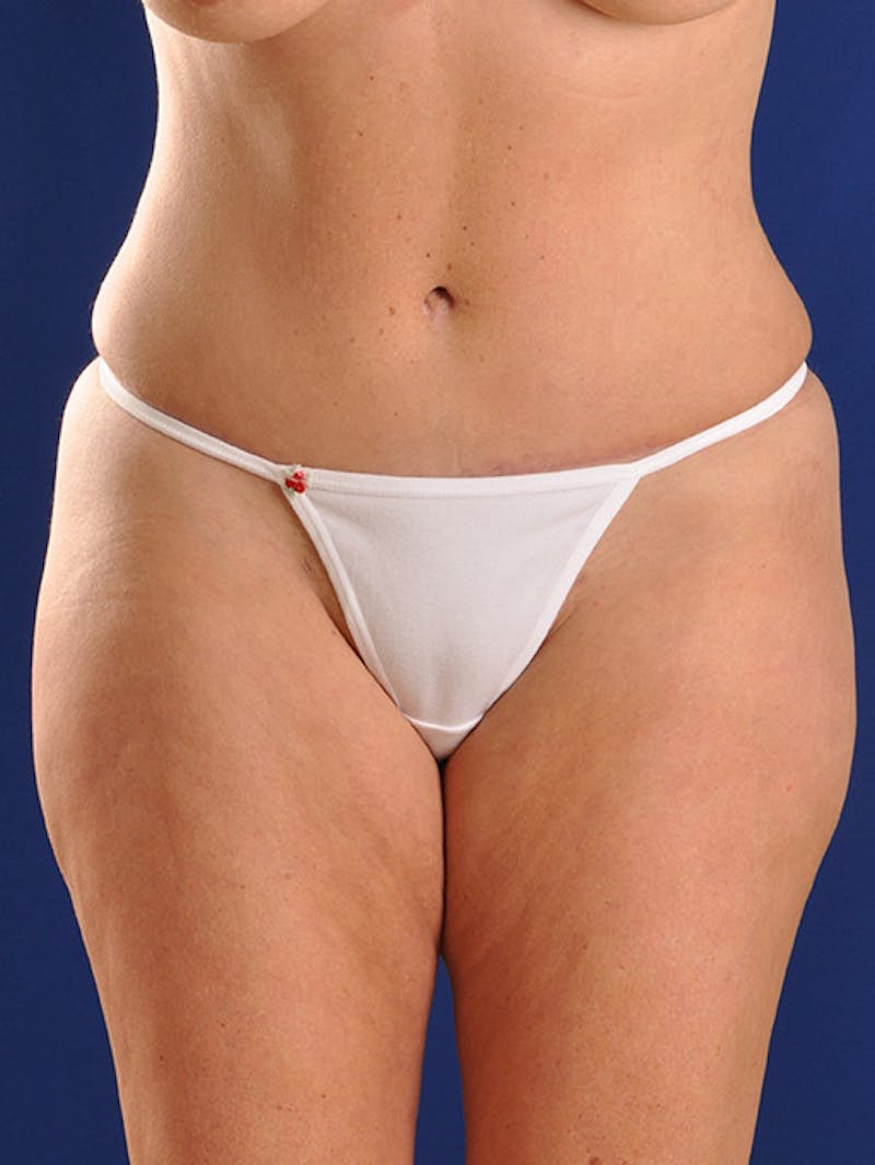 Abdominoplasty / Tummy Tuck Before & After Gallery - Patient 18242440 - Image 2