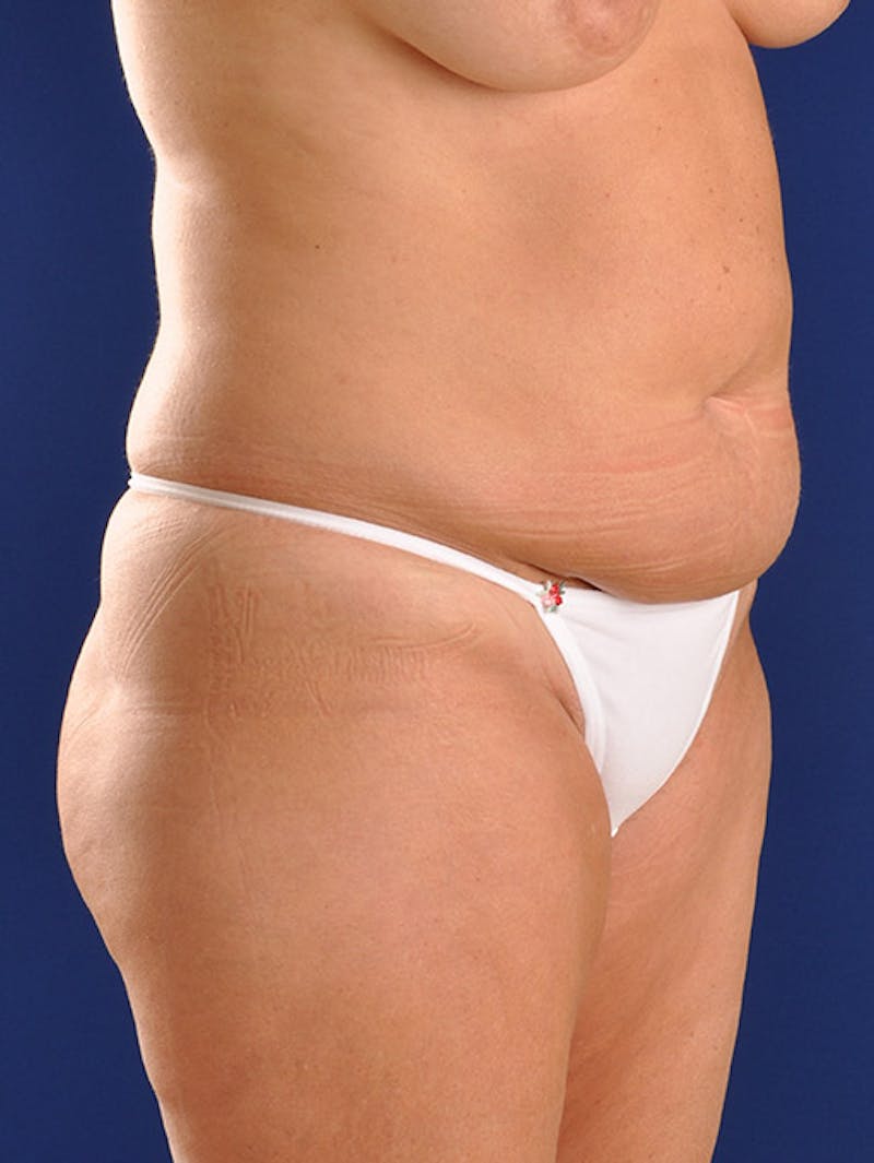 Abdominoplasty / Tummy Tuck Before & After Gallery - Patient 18242440 - Image 3