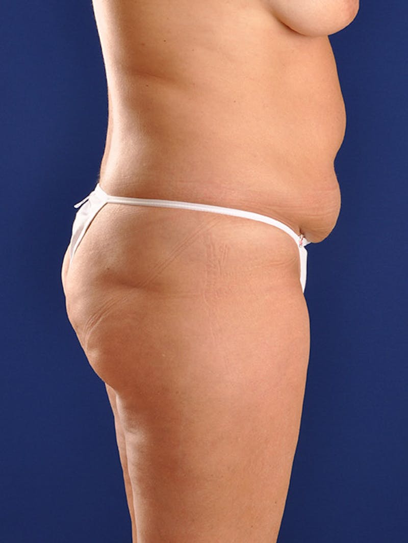 Abdominoplasty / Tummy Tuck Before & After Gallery - Patient 18242440 - Image 5