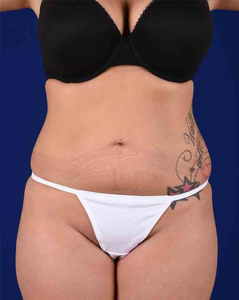 Liposuction Before & After Gallery - Patient 18242443 - Image 1