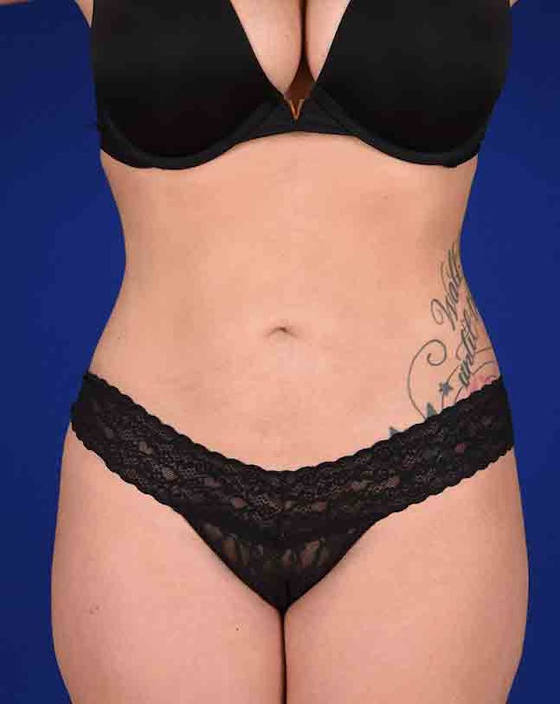 Liposuction Before & After Gallery - Patient 18242443 - Image 2