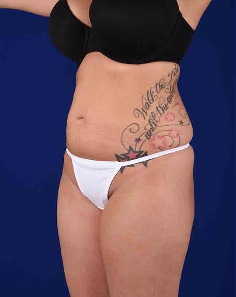 Liposuction Before & After Gallery - Patient 18242443 - Image 3