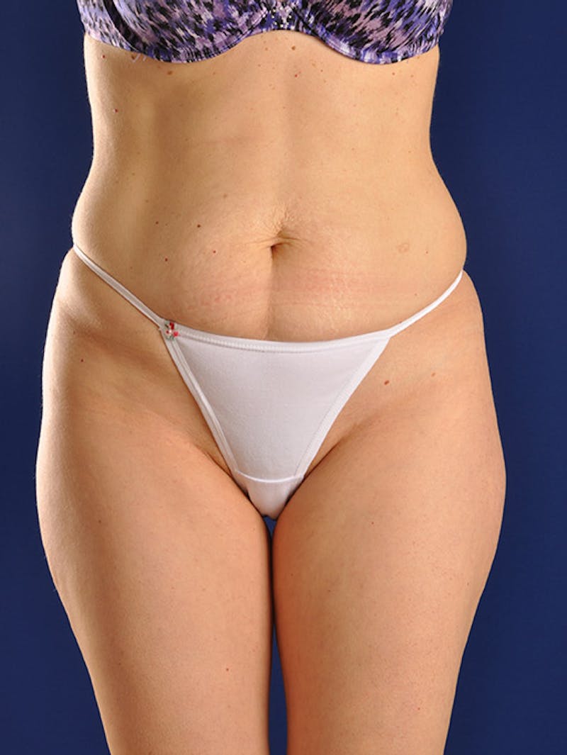Abdominoplasty / Tummy Tuck Before & After Gallery - Patient 18242444 - Image 1