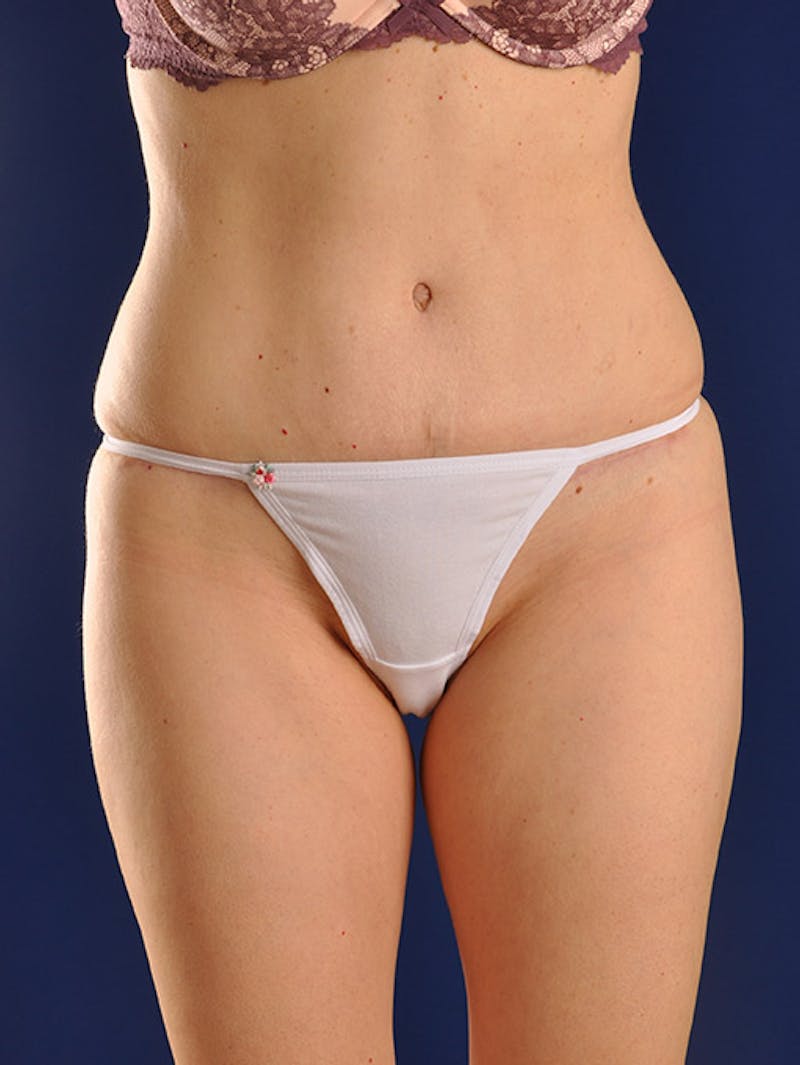 Abdominoplasty / Tummy Tuck Before & After Gallery - Patient 18242444 - Image 2