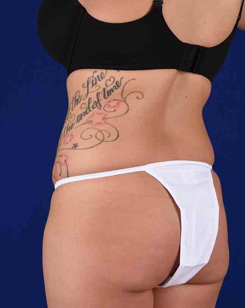 Liposuction Before & After Gallery - Patient 18242443 - Image 5