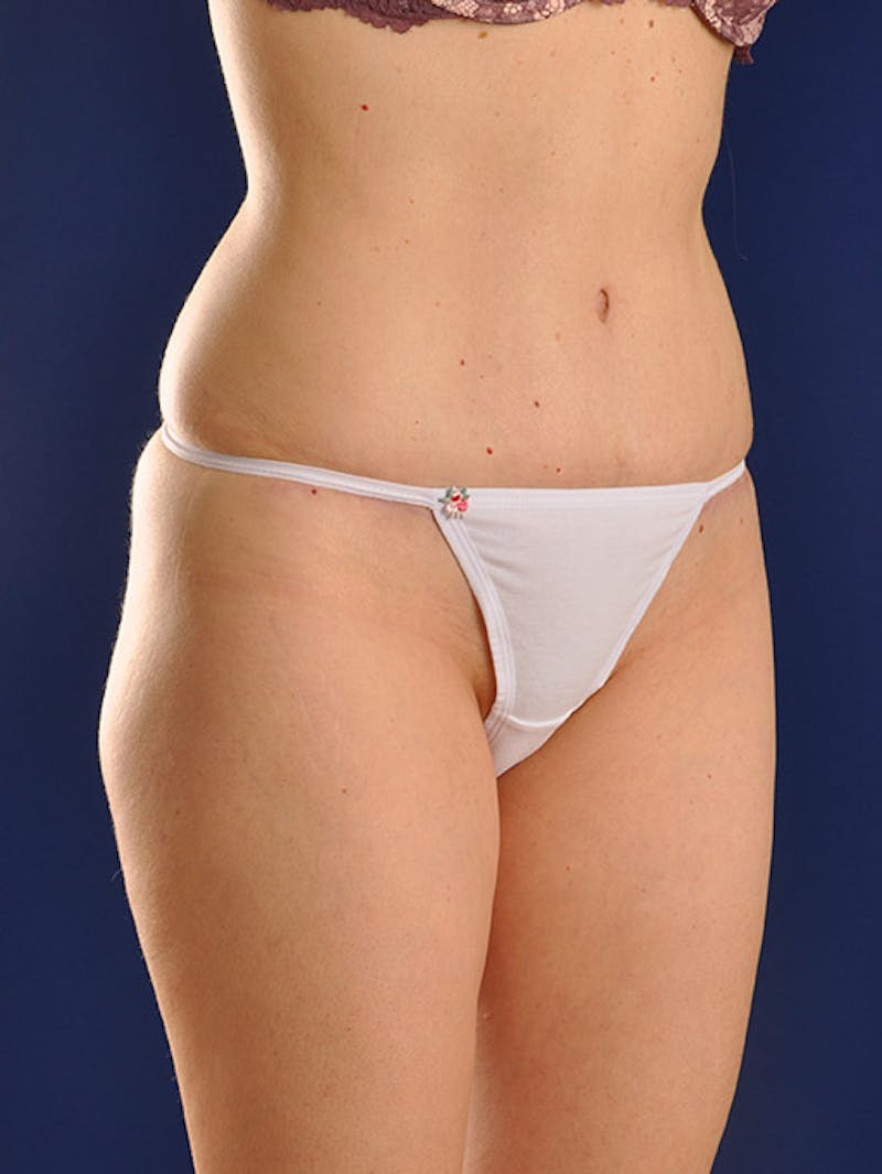 Abdominoplasty / Tummy Tuck Before & After Gallery - Patient 18242444 - Image 4