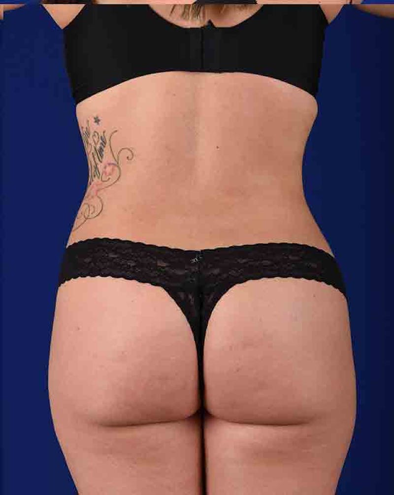 Liposuction Before & After Gallery - Patient 18242443 - Image 8